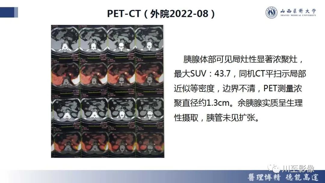 影像PPT - 【PPT】胰腺神经内分泌肿瘤-10