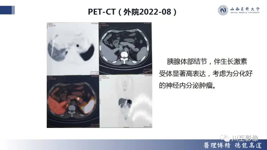 影像PPT - 【PPT】胰腺神经内分泌肿瘤-11