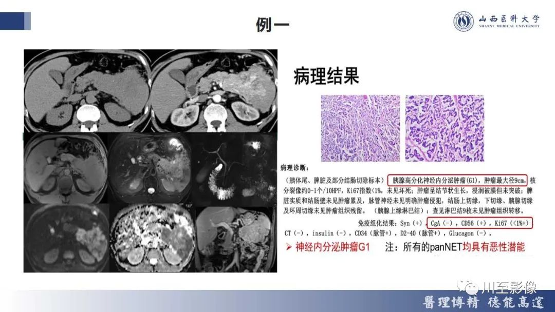 影像PPT - 【PPT】胰腺神经内分泌肿瘤-23