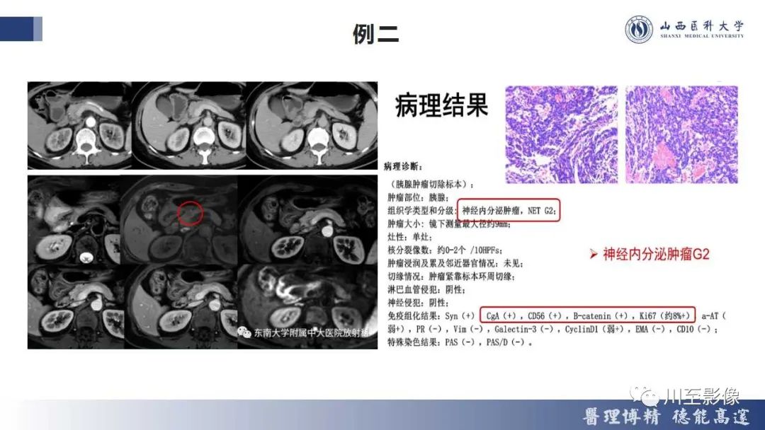影像PPT - 【PPT】胰腺神经内分泌肿瘤-24
