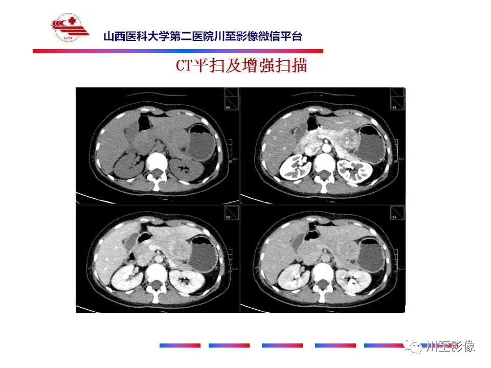 影像PPT - 【PPT】肝脏血管周上皮样细胞肿瘤-5