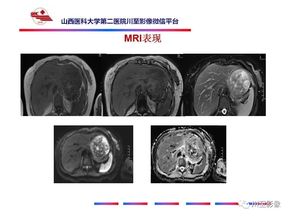 影像PPT - 【PPT】肝脏血管周上皮样细胞肿瘤-7