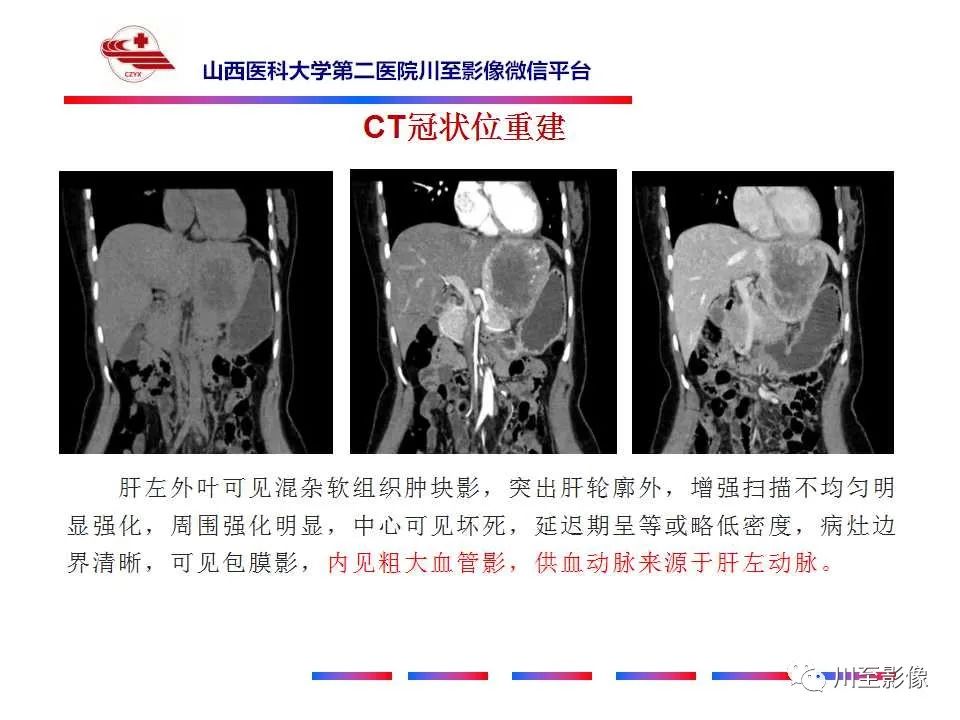 影像PPT - 【PPT】肝脏血管周上皮样细胞肿瘤-6