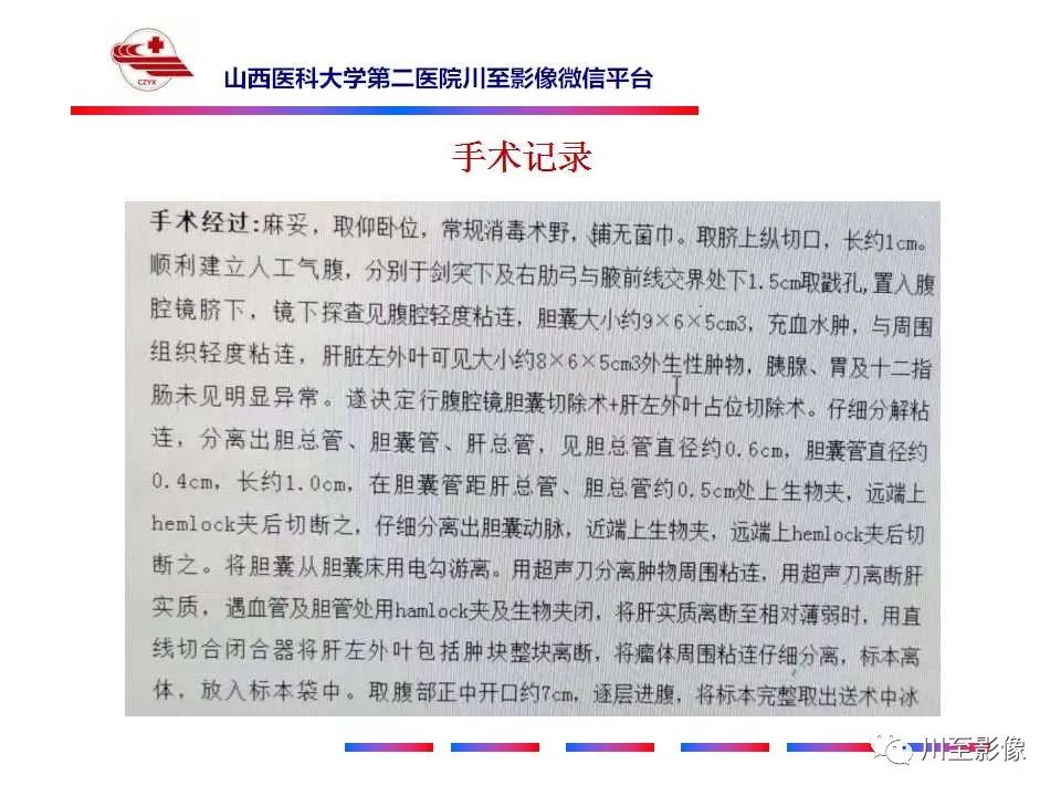 影像PPT - 【PPT】肝脏血管周上皮样细胞肿瘤-9