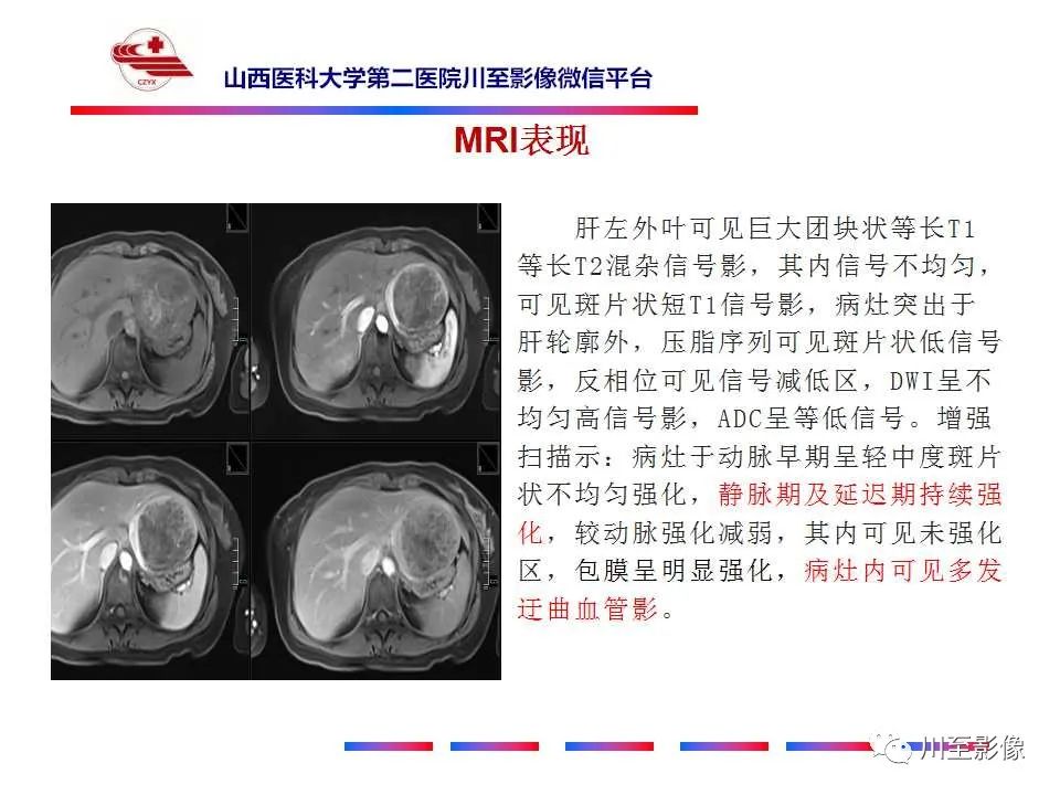 影像PPT - 【PPT】肝脏血管周上皮样细胞肿瘤-8
