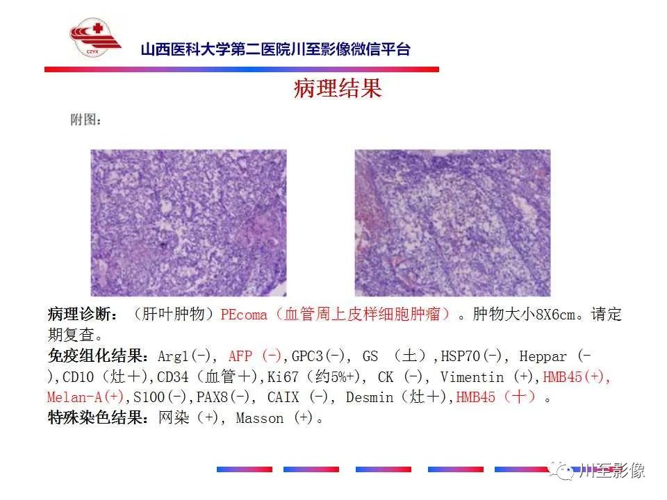 影像PPT - 【PPT】肝脏血管周上皮样细胞肿瘤-10
