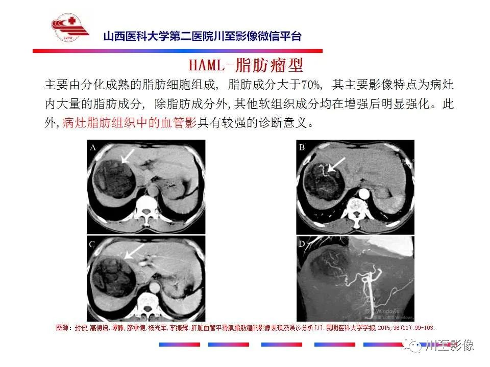 影像PPT - 【PPT】肝脏血管周上皮样细胞肿瘤-21