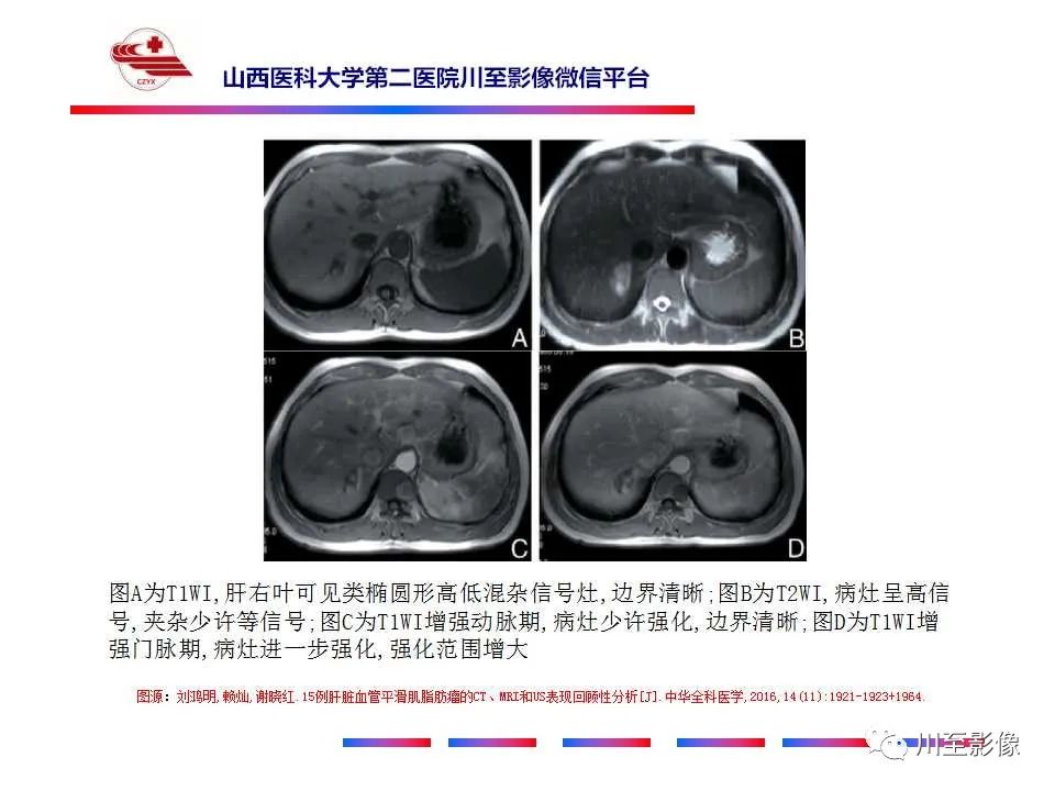 影像PPT - 【PPT】肝脏血管周上皮样细胞肿瘤-22