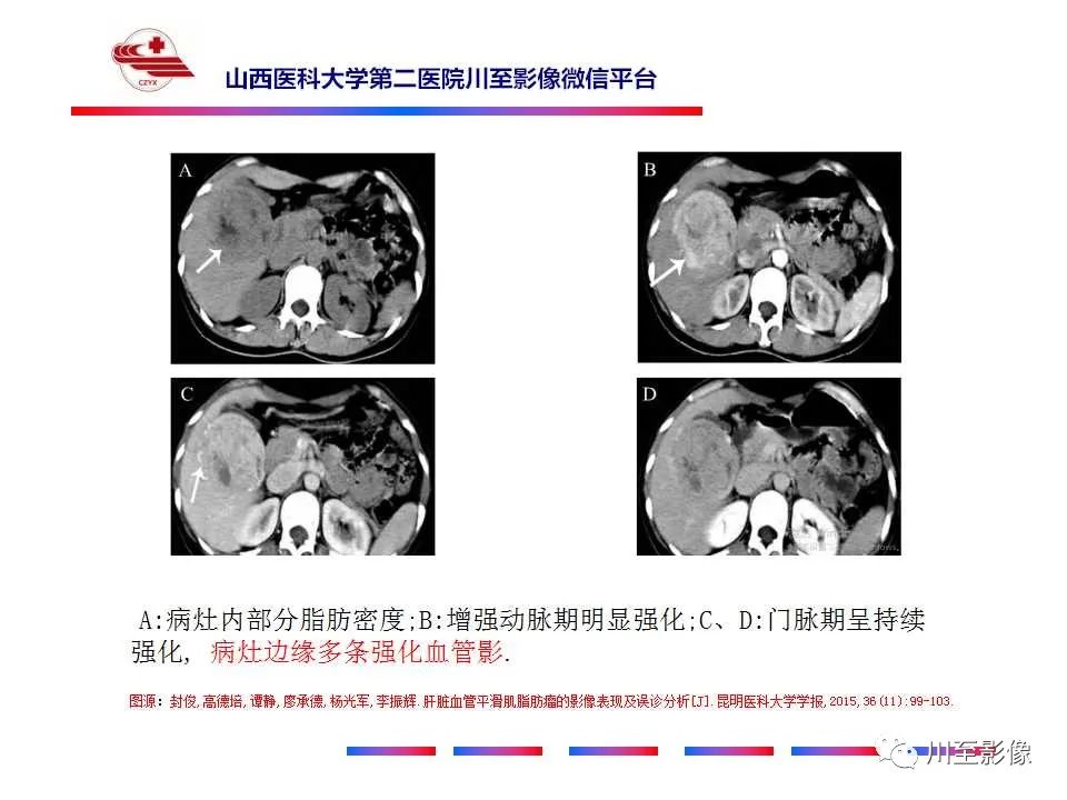 影像PPT - 【PPT】肝脏血管周上皮样细胞肿瘤-24