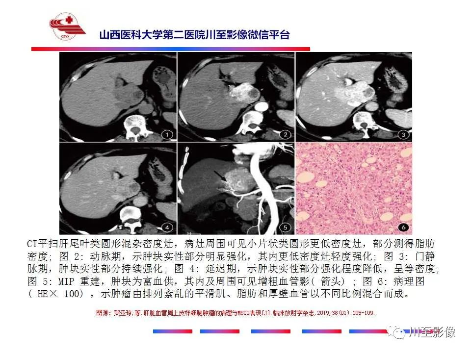 影像PPT - 【PPT】肝脏血管周上皮样细胞肿瘤-25