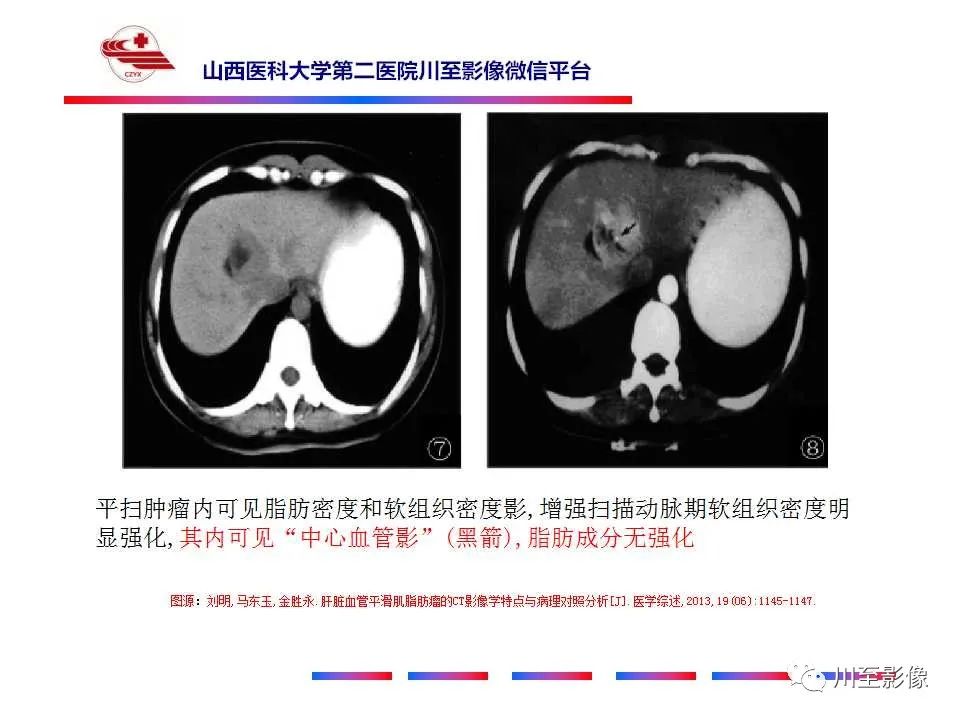 影像PPT - 【PPT】肝脏血管周上皮样细胞肿瘤-26