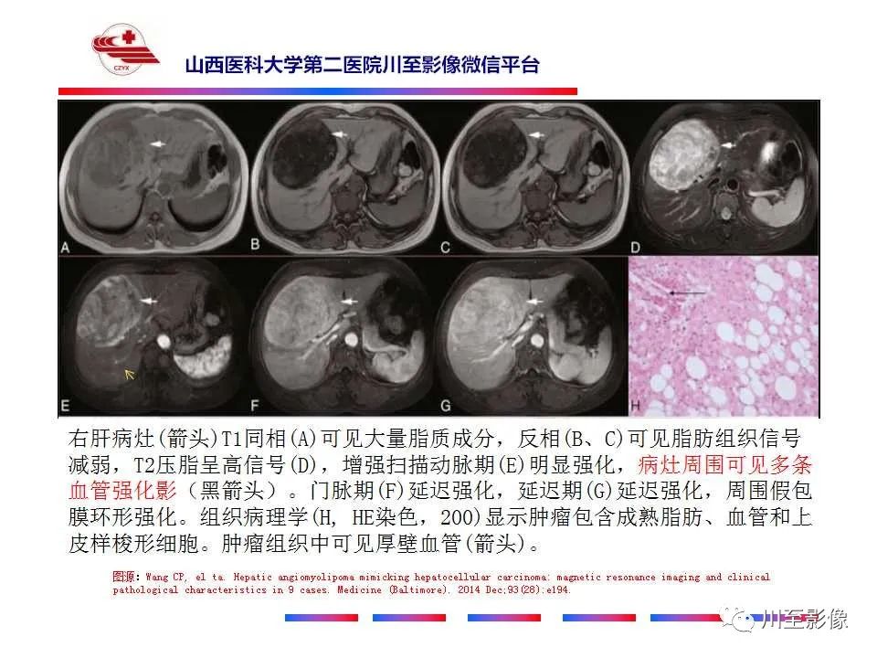 影像PPT - 【PPT】肝脏血管周上皮样细胞肿瘤-27