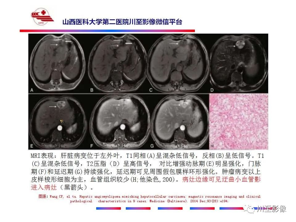 影像PPT - 【PPT】肝脏血管周上皮样细胞肿瘤-30