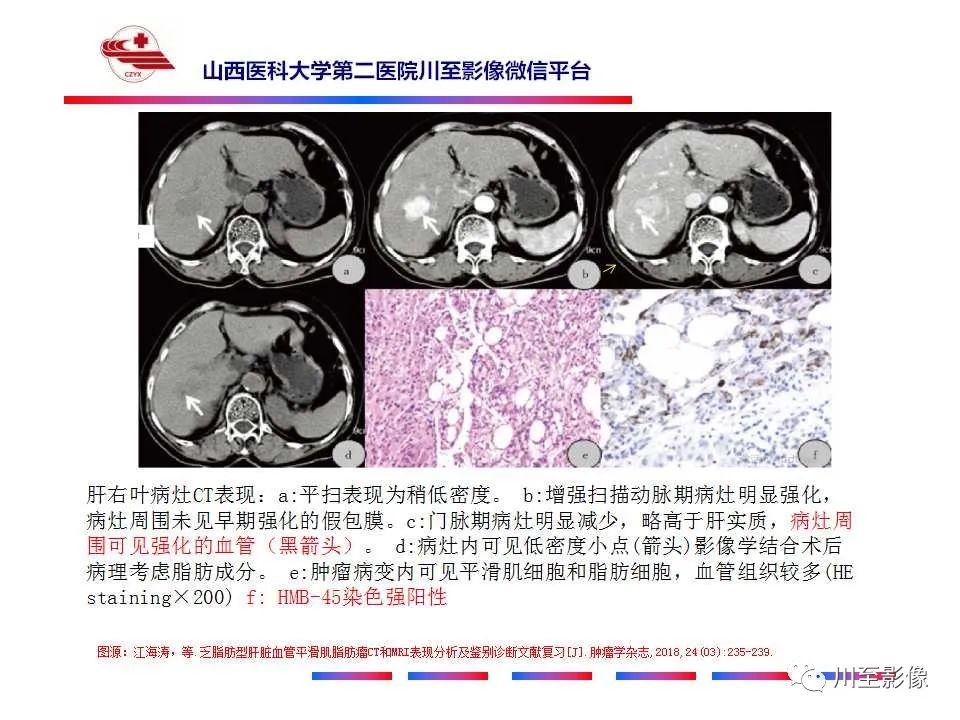 影像PPT - 【PPT】肝脏血管周上皮样细胞肿瘤-32