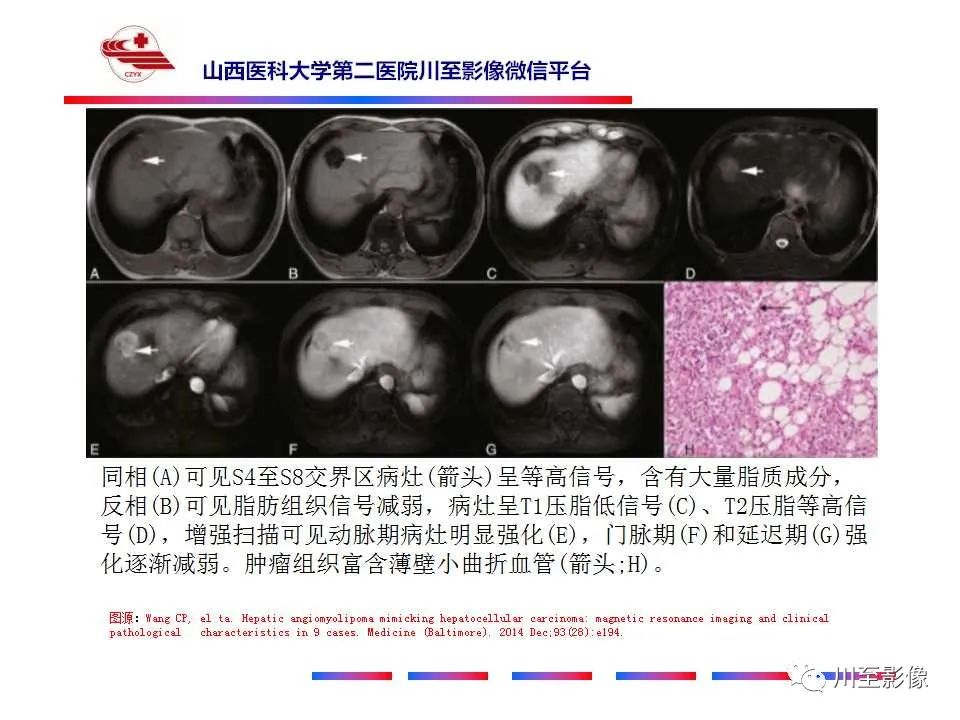 影像PPT - 【PPT】肝脏血管周上皮样细胞肿瘤-28