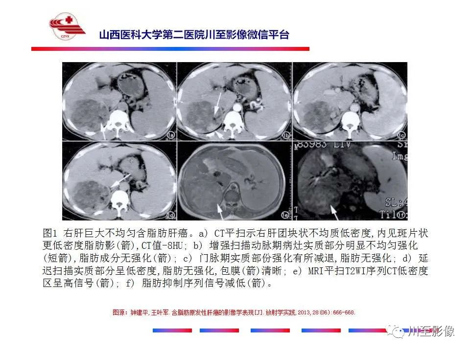 影像PPT - 【PPT】肝脏血管周上皮样细胞肿瘤-36