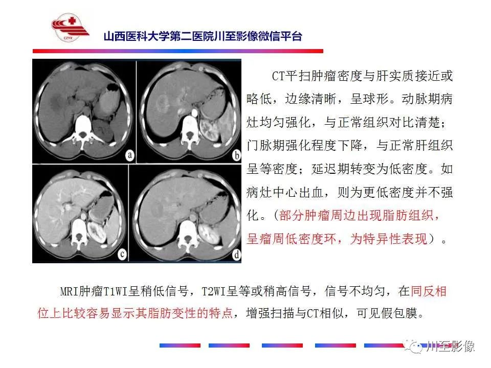 影像PPT - 【PPT】肝脏血管周上皮样细胞肿瘤-38