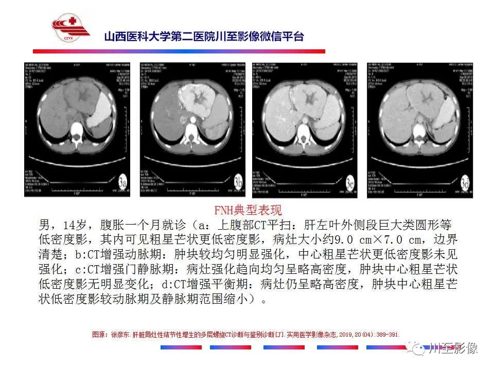 影像PPT - 【PPT】肝脏血管周上皮样细胞肿瘤-41