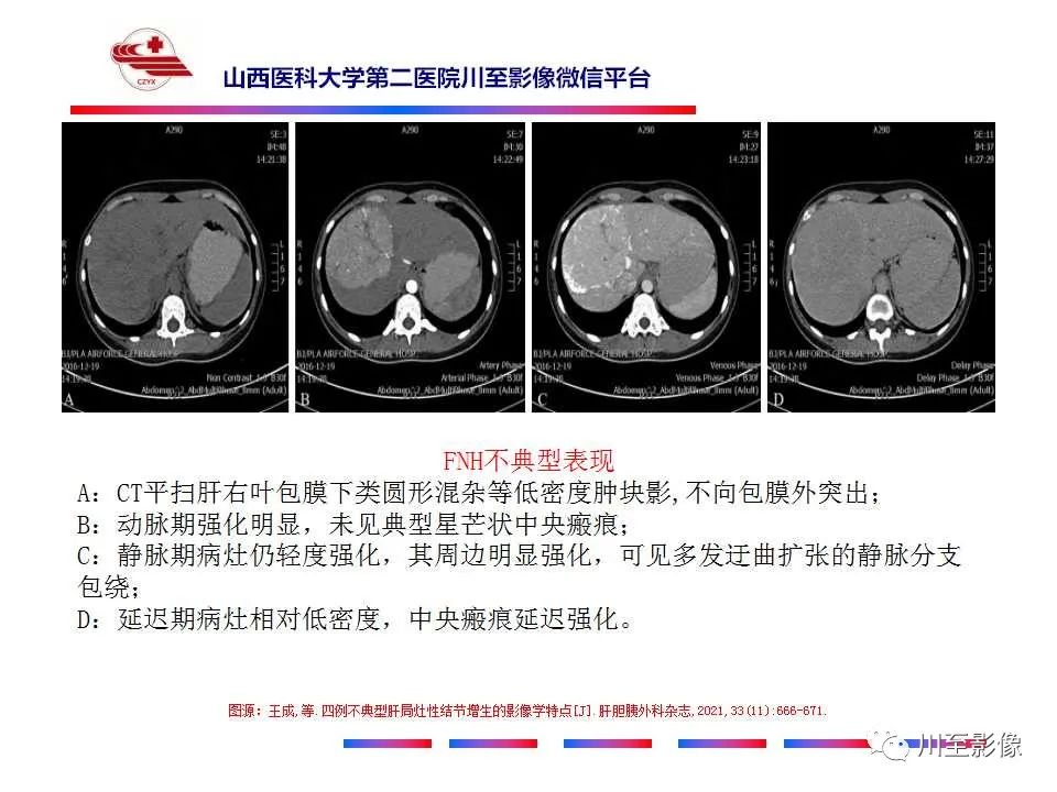 影像PPT - 【PPT】肝脏血管周上皮样细胞肿瘤-42