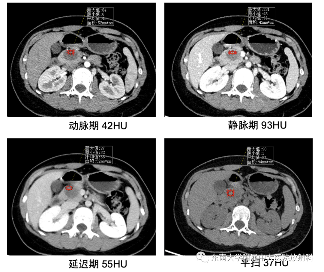 影像PPT - 【PPT】胰腺实性假乳头状瘤-2 影像PPT - 【PPT】胰腺实性假乳头状瘤-2