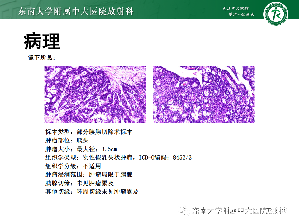 影像PPT - 【PPT】胰腺实性假乳头状瘤-4 影像PPT - 【PPT】胰腺实性假乳头状瘤-4