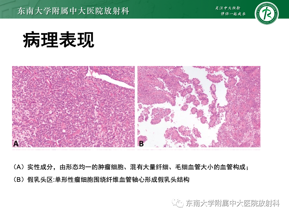 影像PPT - 【PPT】胰腺实性假乳头状瘤-9 影像PPT - 【PPT】胰腺实性假乳头状瘤-9