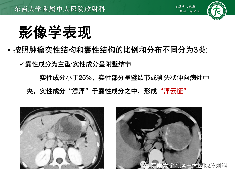 影像PPT - 【PPT】胰腺实性假乳头状瘤-12 影像PPT - 【PPT】胰腺实性假乳头状瘤-12