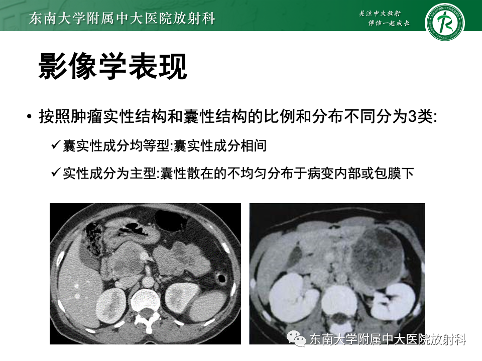 影像PPT - 【PPT】胰腺实性假乳头状瘤-13 影像PPT - 【PPT】胰腺实性假乳头状瘤-13