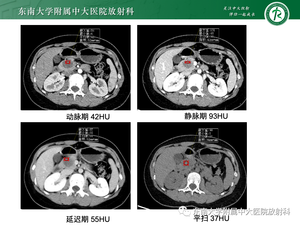 影像PPT - 【PPT】胰腺实性假乳头状瘤-15 影像PPT - 【PPT】胰腺实性假乳头状瘤-15