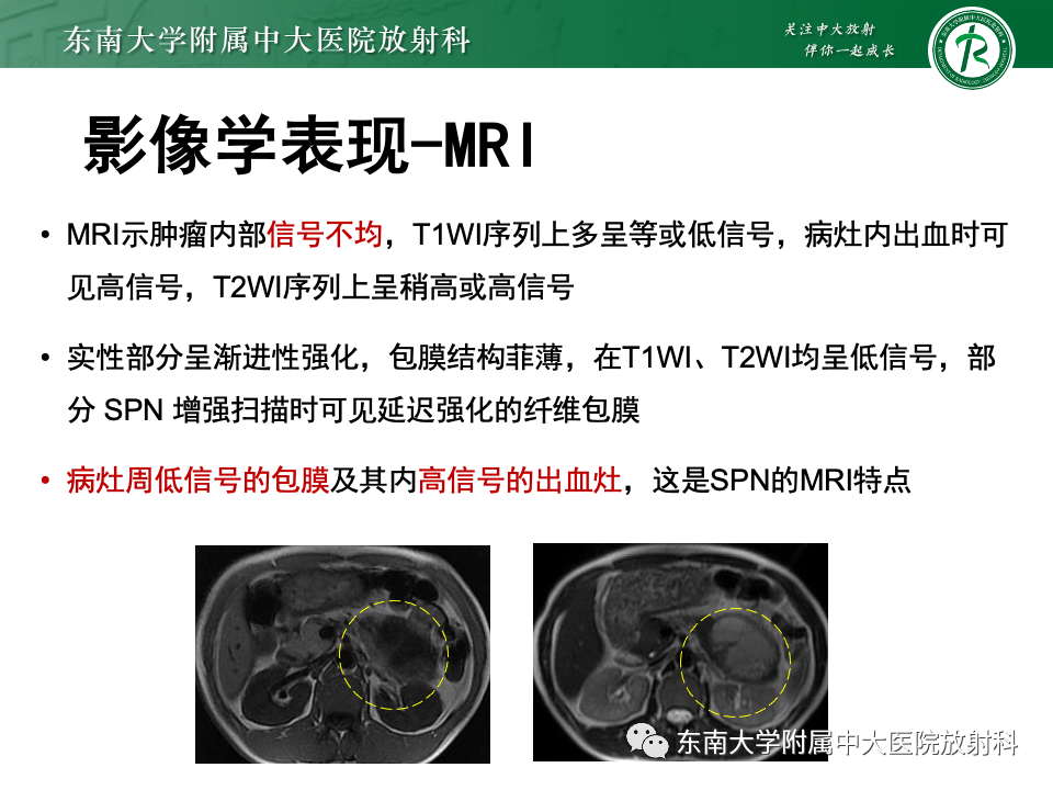 影像PPT - 【PPT】胰腺实性假乳头状瘤-16 影像PPT - 【PPT】胰腺实性假乳头状瘤-16