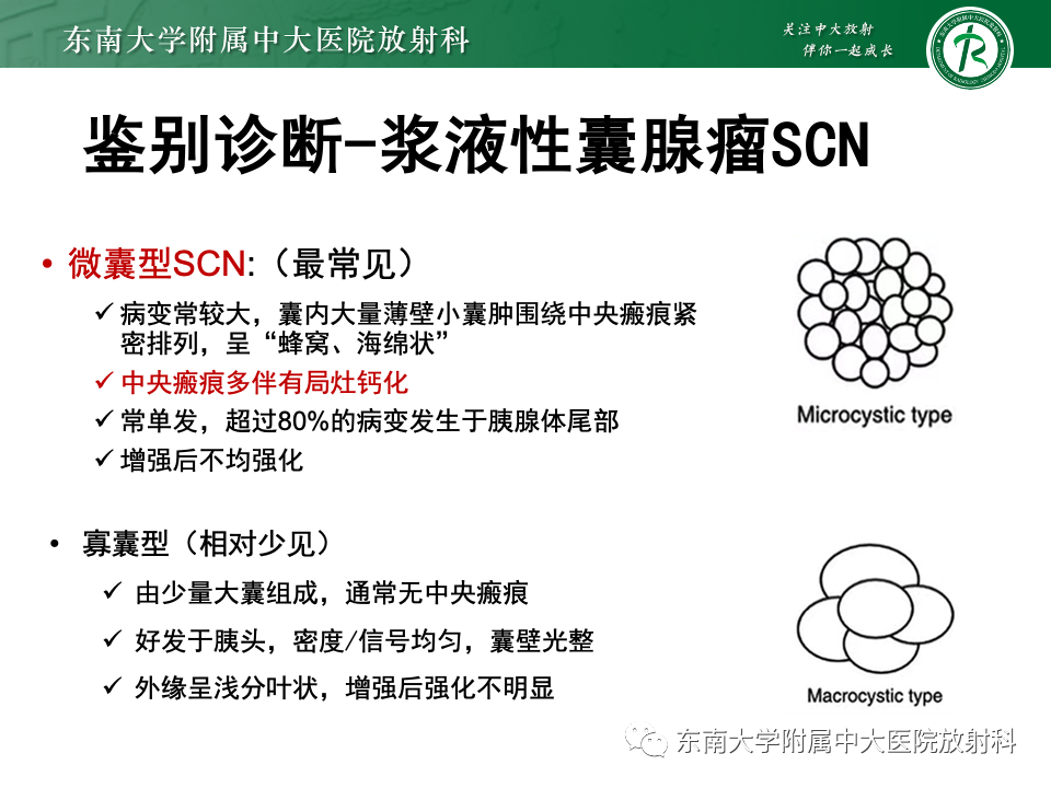 影像PPT - 【PPT】胰腺实性假乳头状瘤-21 影像PPT - 【PPT】胰腺实性假乳头状瘤-21