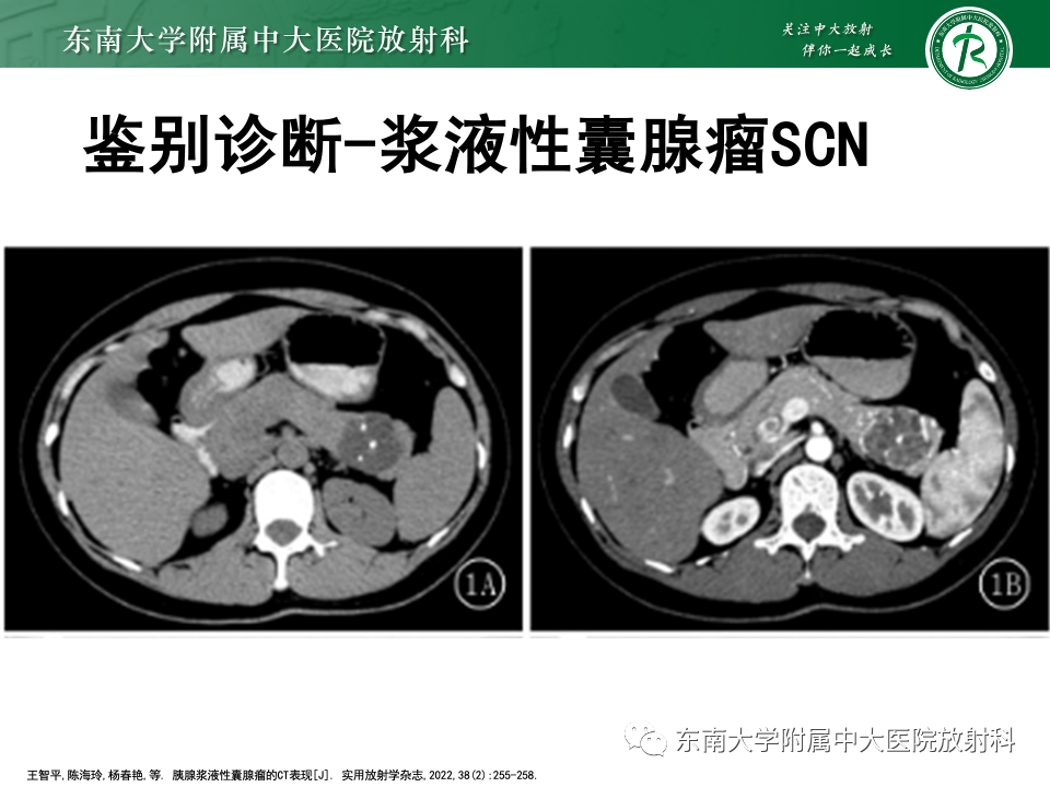 影像PPT - 【PPT】胰腺实性假乳头状瘤-22 影像PPT - 【PPT】胰腺实性假乳头状瘤-22