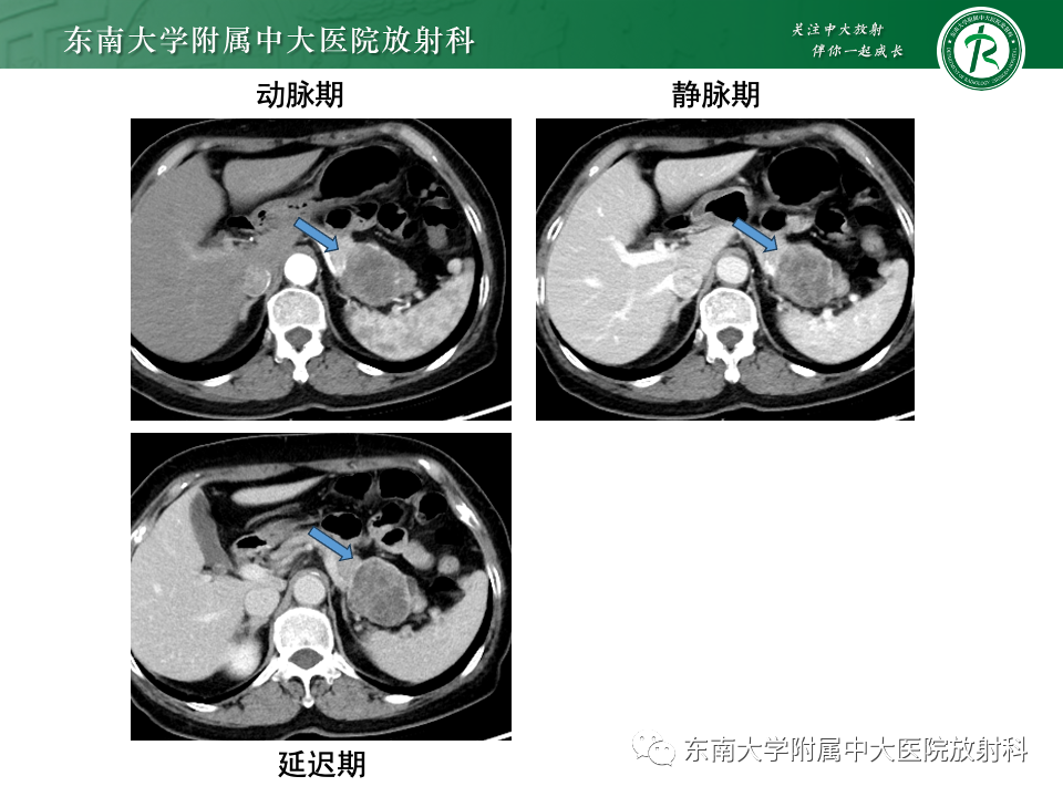 影像PPT - 【PPT】胰腺实性假乳头状瘤-23 影像PPT - 【PPT】胰腺实性假乳头状瘤-23