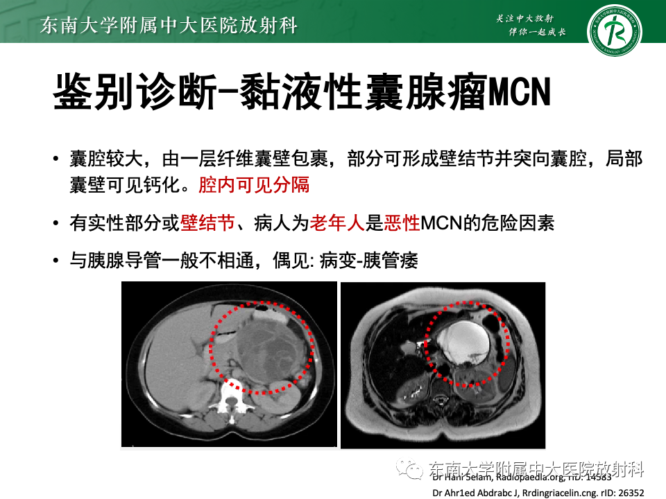 影像PPT - 【PPT】胰腺实性假乳头状瘤-25 影像PPT - 【PPT】胰腺实性假乳头状瘤-25