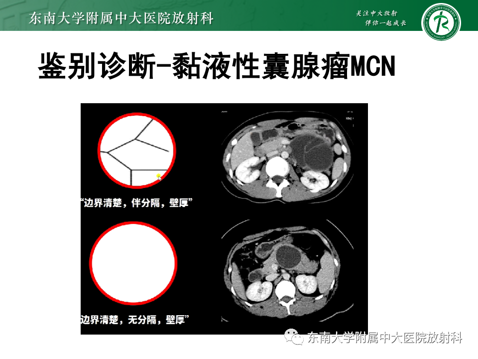 影像PPT - 【PPT】胰腺实性假乳头状瘤-26 影像PPT - 【PPT】胰腺实性假乳头状瘤-26