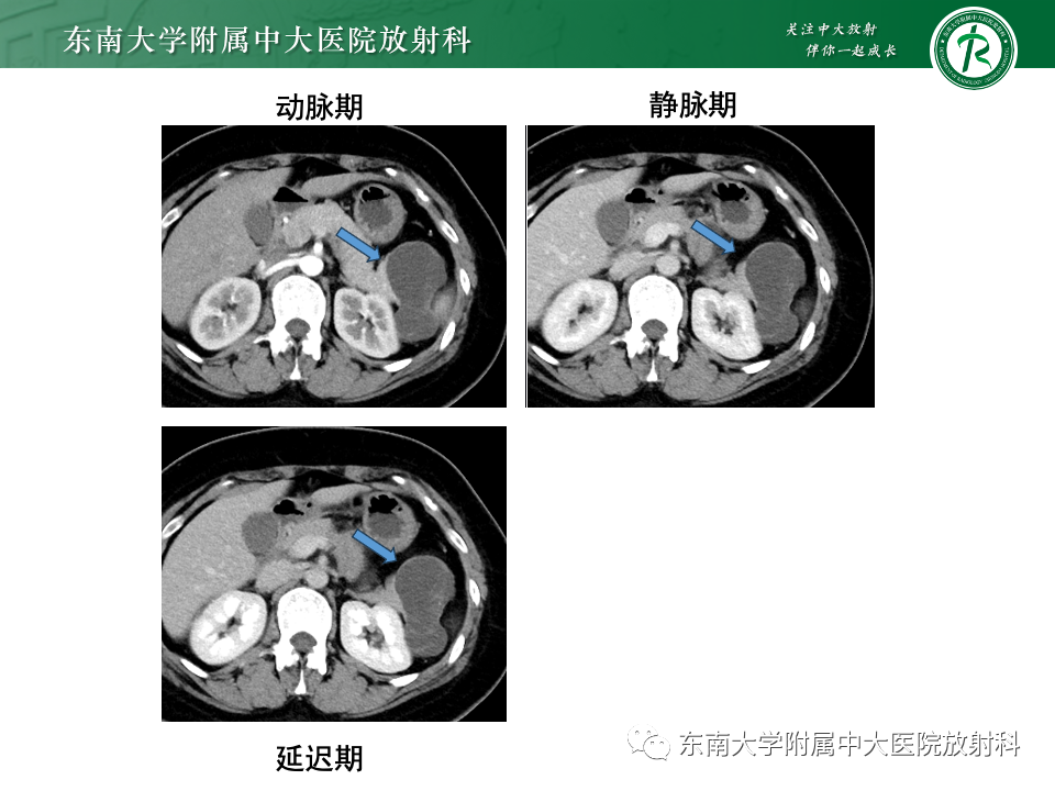 影像PPT - 【PPT】胰腺实性假乳头状瘤-27 影像PPT - 【PPT】胰腺实性假乳头状瘤-27