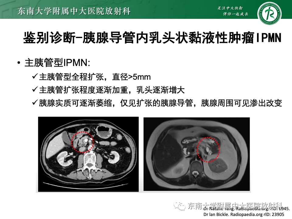 影像PPT - 【PPT】胰腺实性假乳头状瘤-29 影像PPT - 【PPT】胰腺实性假乳头状瘤-29