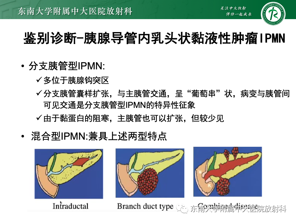 影像PPT - 【PPT】胰腺实性假乳头状瘤-30 影像PPT - 【PPT】胰腺实性假乳头状瘤-30