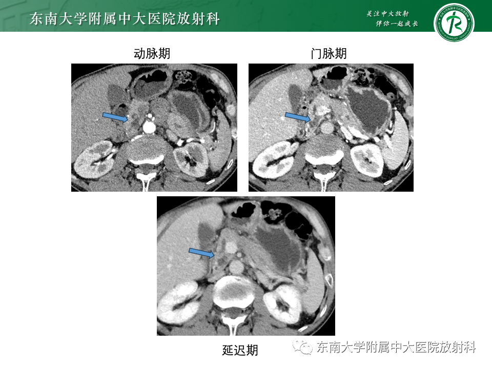 影像PPT - 【PPT】胰腺实性假乳头状瘤-31 影像PPT - 【PPT】胰腺实性假乳头状瘤-31