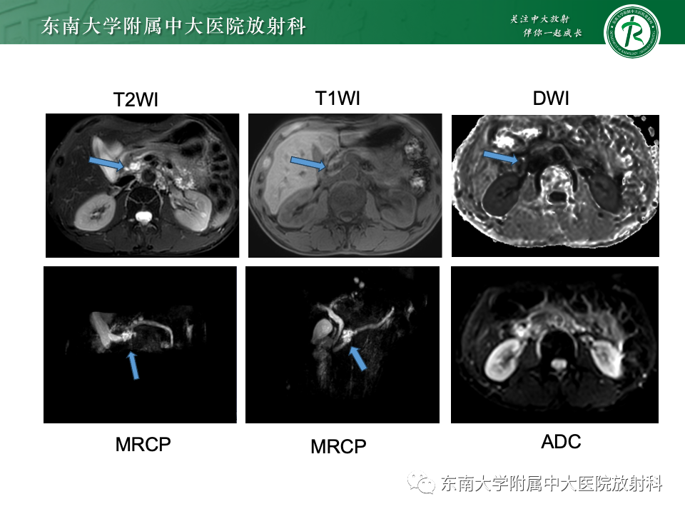 影像PPT - 【PPT】胰腺实性假乳头状瘤-32 影像PPT - 【PPT】胰腺实性假乳头状瘤-32