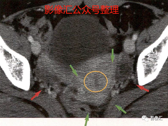 影像PPT - 妇科急腹症影像要点:定位、卵巢出血、卵巢肿块蒂扭转、异位妊娠及囊肿破裂-1 影像PPT - 妇科急腹症影像要点:定位、卵巢出血、卵巢肿块蒂扭转、异位妊娠及囊肿破裂-1