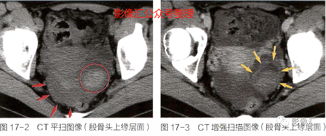 影像PPT - 妇科急腹症影像要点:定位、卵巢出血、卵巢肿块蒂扭转、异位妊娠及囊肿破裂-2 影像PPT - 妇科急腹症影像要点:定位、卵巢出血、卵巢肿块蒂扭转、异位妊娠及囊肿破裂-2