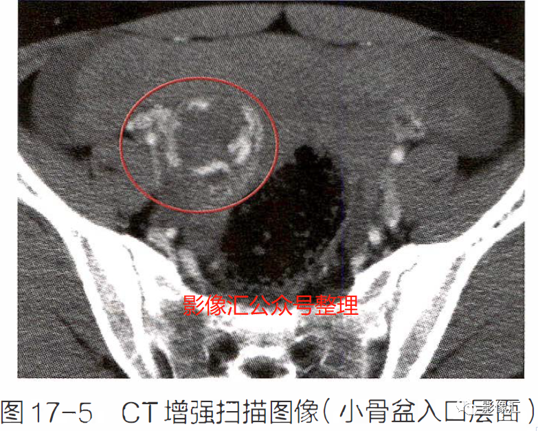 影像PPT - 妇科急腹症影像要点:定位、卵巢出血、卵巢肿块蒂扭转、异位妊娠及囊肿破裂-4 影像PPT - 妇科急腹症影像要点:定位、卵巢出血、卵巢肿块蒂扭转、异位妊娠及囊肿破裂-4