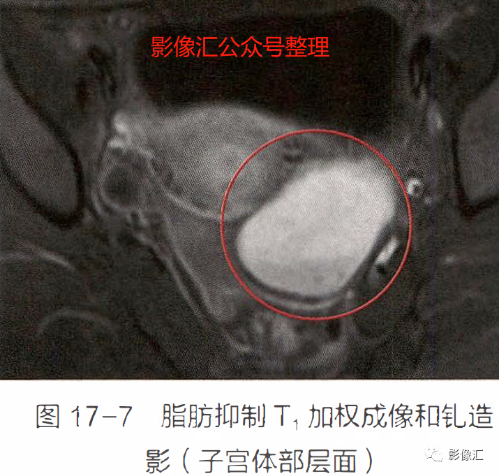 影像PPT - 妇科急腹症影像要点:定位、卵巢出血、卵巢肿块蒂扭转、异位妊娠及囊肿破裂-6 影像PPT - 妇科急腹症影像要点:定位、卵巢出血、卵巢肿块蒂扭转、异位妊娠及囊肿破裂-6