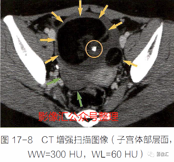 影像PPT - 妇科急腹症影像要点:定位、卵巢出血、卵巢肿块蒂扭转、异位妊娠及囊肿破裂-7 影像PPT - 妇科急腹症影像要点:定位、卵巢出血、卵巢肿块蒂扭转、异位妊娠及囊肿破裂-7