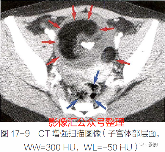 影像PPT - 妇科急腹症影像要点:定位、卵巢出血、卵巢肿块蒂扭转、异位妊娠及囊肿破裂-8 影像PPT - 妇科急腹症影像要点:定位、卵巢出血、卵巢肿块蒂扭转、异位妊娠及囊肿破裂-8