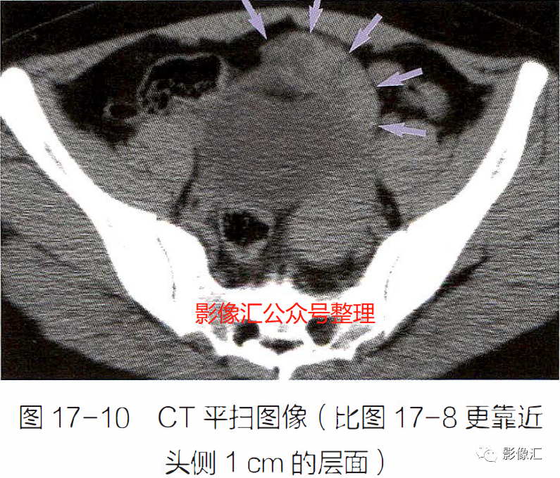 影像PPT - 妇科急腹症影像要点:定位、卵巢出血、卵巢肿块蒂扭转、异位妊娠及囊肿破裂-9 影像PPT - 妇科急腹症影像要点:定位、卵巢出血、卵巢肿块蒂扭转、异位妊娠及囊肿破裂-9