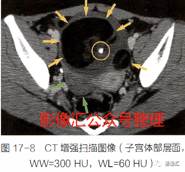 影像PPT - 妇科急腹症影像要点:定位、卵巢出血、卵巢肿块蒂扭转、异位妊娠及囊肿破裂-11 影像PPT - 妇科急腹症影像要点:定位、卵巢出血、卵巢肿块蒂扭转、异位妊娠及囊肿破裂-11