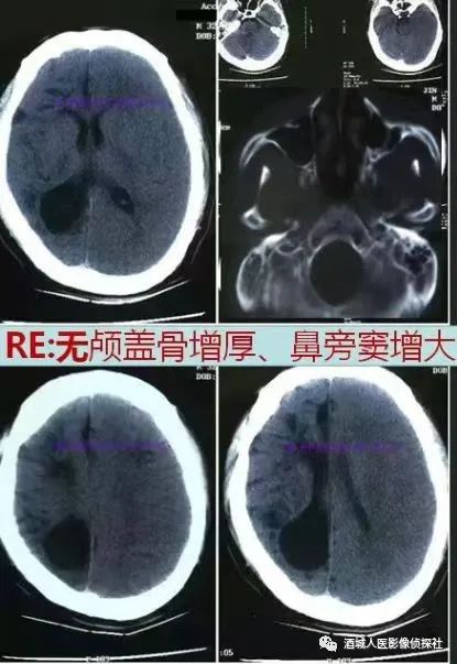 影像PPT - 脑性偏身萎缩综合征DDMS-2 影像PPT - 脑性偏身萎缩综合征DDMS-2