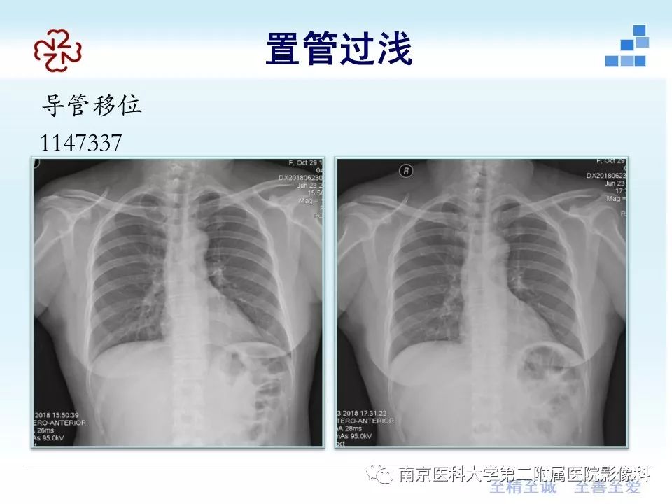 影像PPT - 【PPT】PICC管尖端胸片定位-6